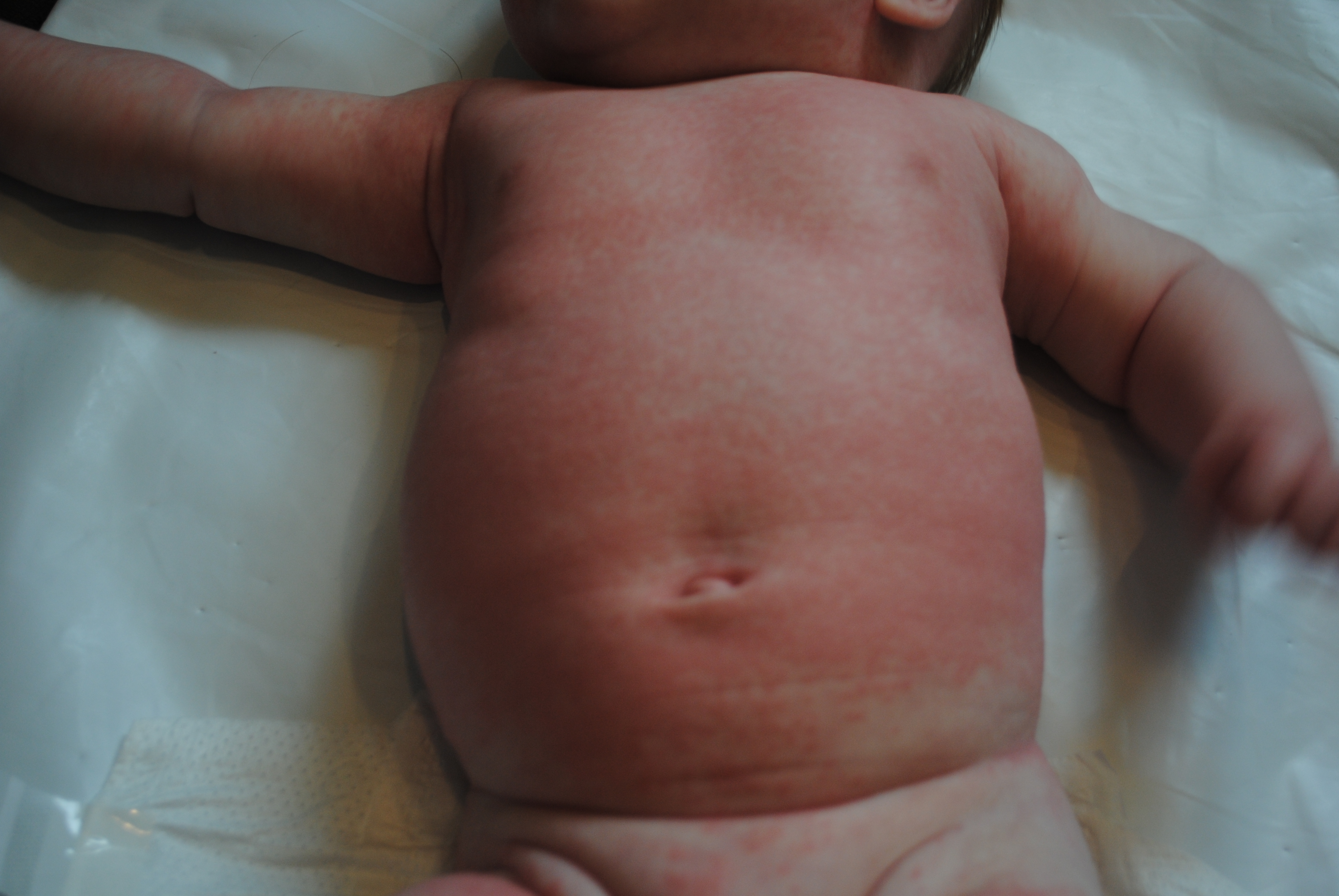 Newborn eczema baby skin and allergies