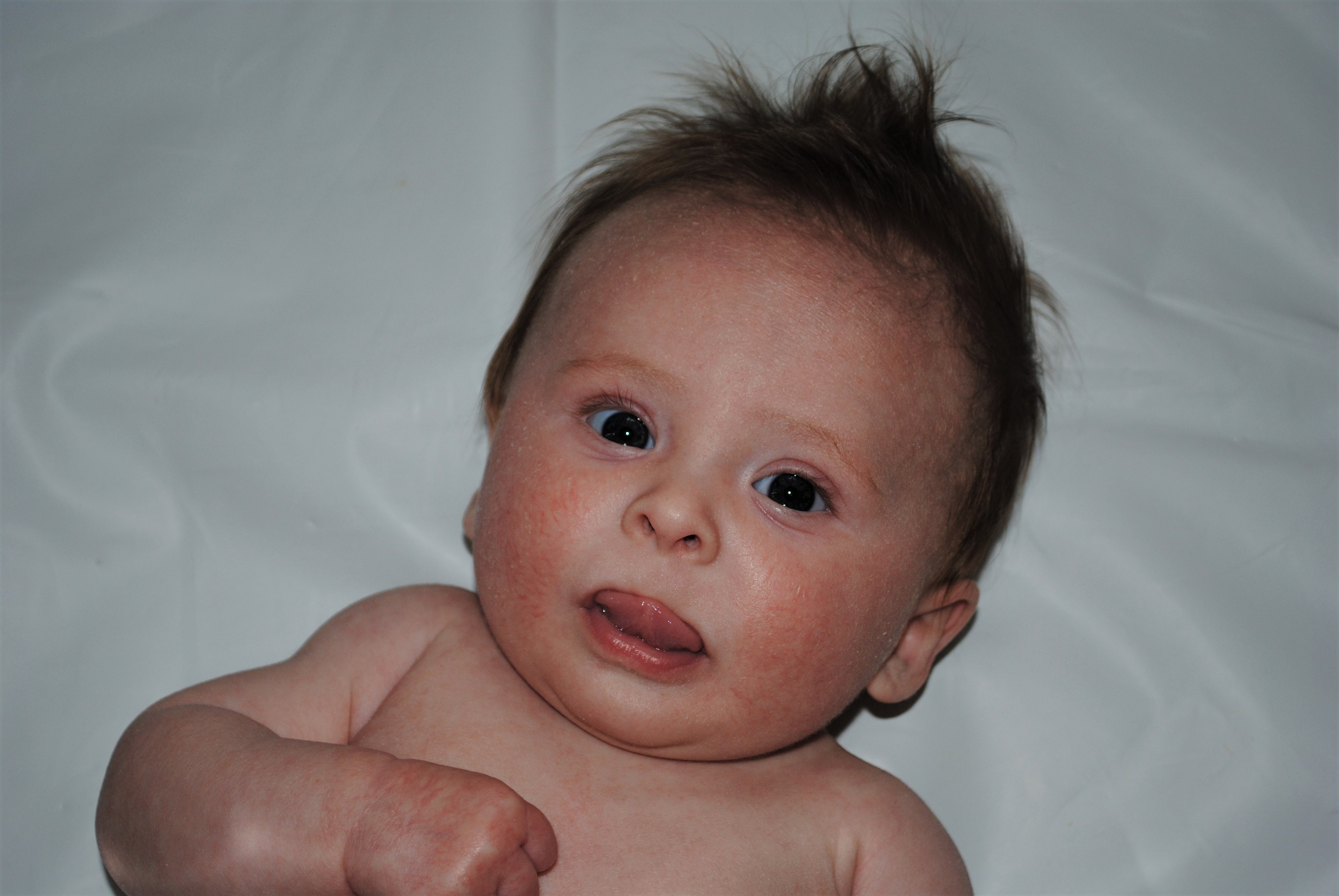 Newborn eczema baby skin and allergies